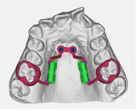 Distalizzatore su 2 TADs