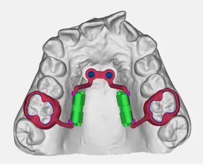 Distalizzatore su 2 TADs